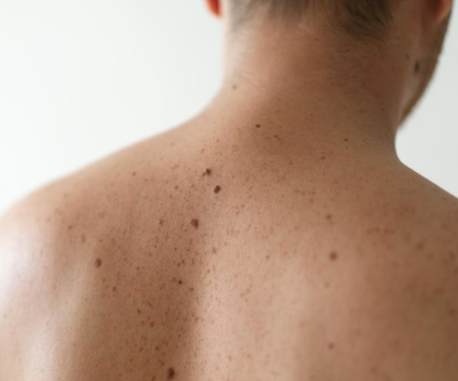 मस्से जल्द सूखते हैं