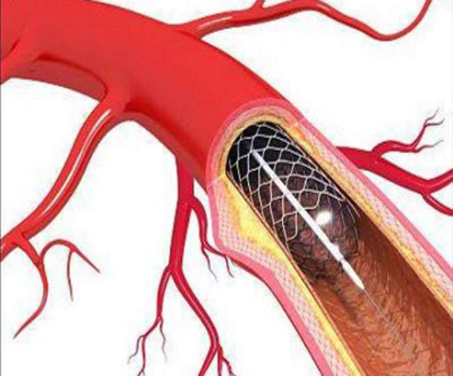 स्टेंट की कीमतों के मुद्दे पर अमेरिकी सांसदों ने किया पुनर्विचार का आग्रह