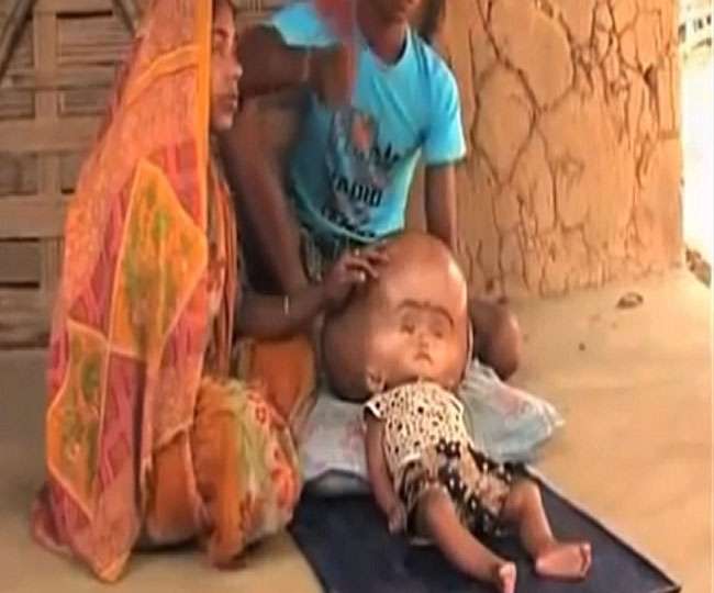 इलाज के अभाव में बड़े सिर वाले बच्ची की मौत, अगले महीने होनी थी सर्जरी