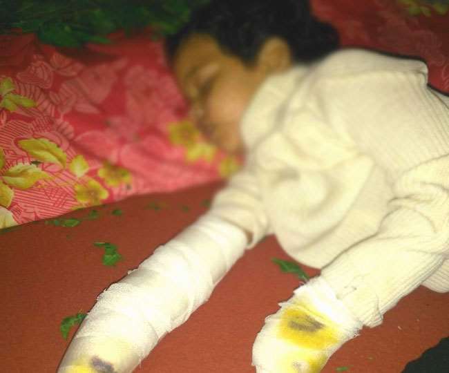 Jharkhand: बच्ची का टूटा दायां हाथ... डॉक्टर ने बाएं हाथ में प्लास्टर कर दिया...