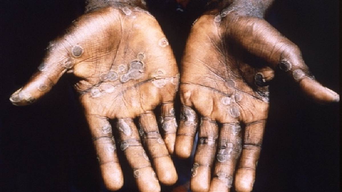 Monkeypox Cases : अब तक 12 देशों में मंकीपाक्स के आए 92 मामले, WHO ने कहा- वैश्विक स्तर पर फैल सकता है यह वायरस