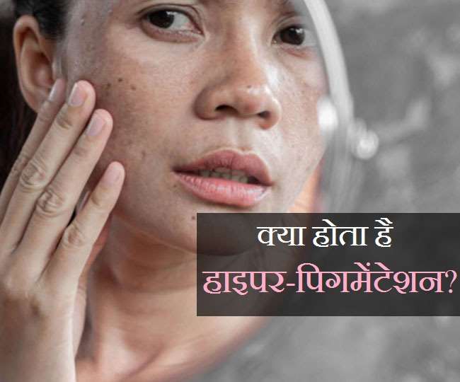 Hyper-pigmentation Remedies: क्या है हाइपर-पिगमेंटेशन और क्या हैं इससे बचने उपाय?