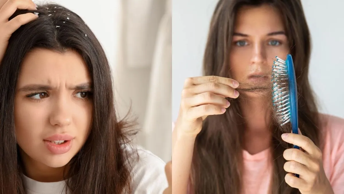 कैसे कंट्रोल करें बालों का झड़ना और डैंड्रफ?