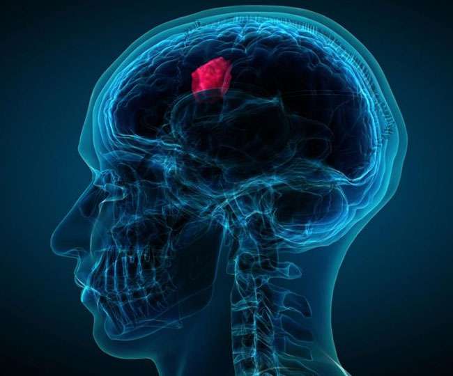 ट्यूमर होने से पहले शरीर देता है यह 3 संकेत, जाने जरुर नहीं तो पछताओगे