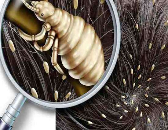 कहीं आपके बच्चे को जुएं तो नहीं कर रहे बीमार - hair lice are ill your child