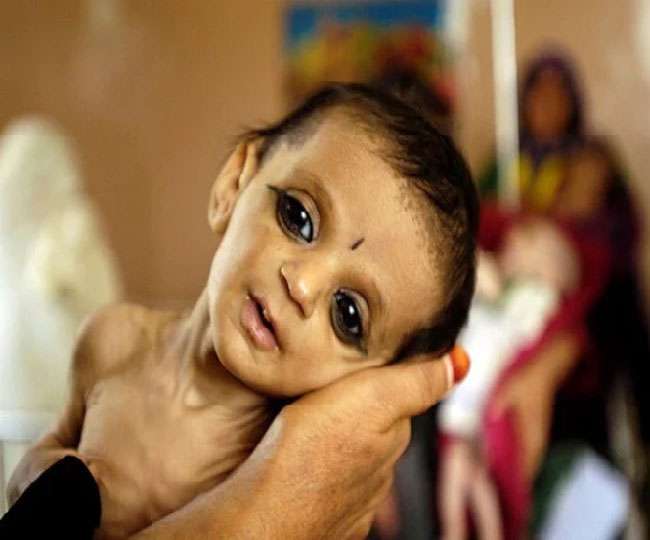 malnutrition in hindi