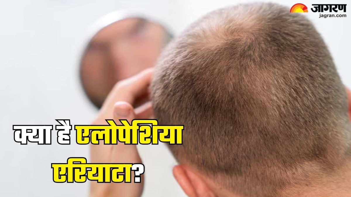 https://www.jagranimages.com/images/2025/06/21/article/image/Alopecia-areata-1750493451946.jpg