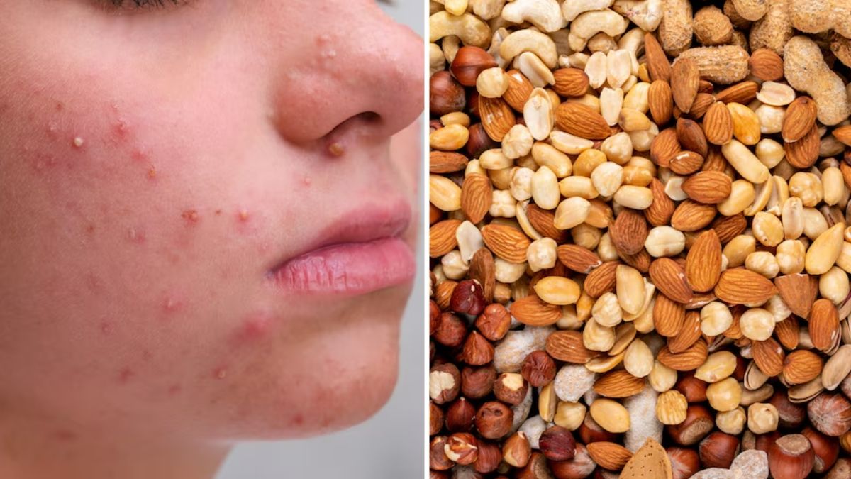 https://www.jagranimages.com/images/2025/06/22/article/image/do-dry-fruits-cause-acne-1750594517785.jpg