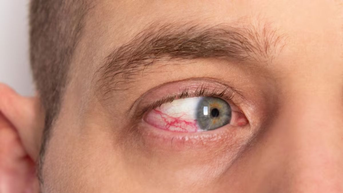 https://www.jagranimages.com/images/2025/06/23/article/image/eye-disease-1750668224007.jpg