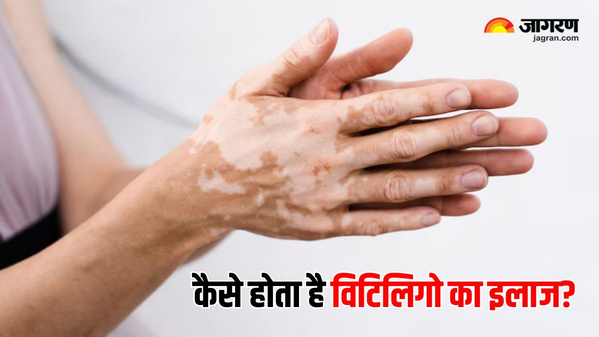 https://www.jagranimages.com/images/2025/06/24/article/image/World-Vitiligo-Day-2025-1750772002564.jpg
