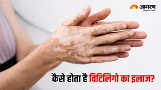 World Vitiligo Day 2025: डॉक्टर ने बताई विटिलिगो से जुड़ी जरूरी बातें (Image Source: Freepik)
