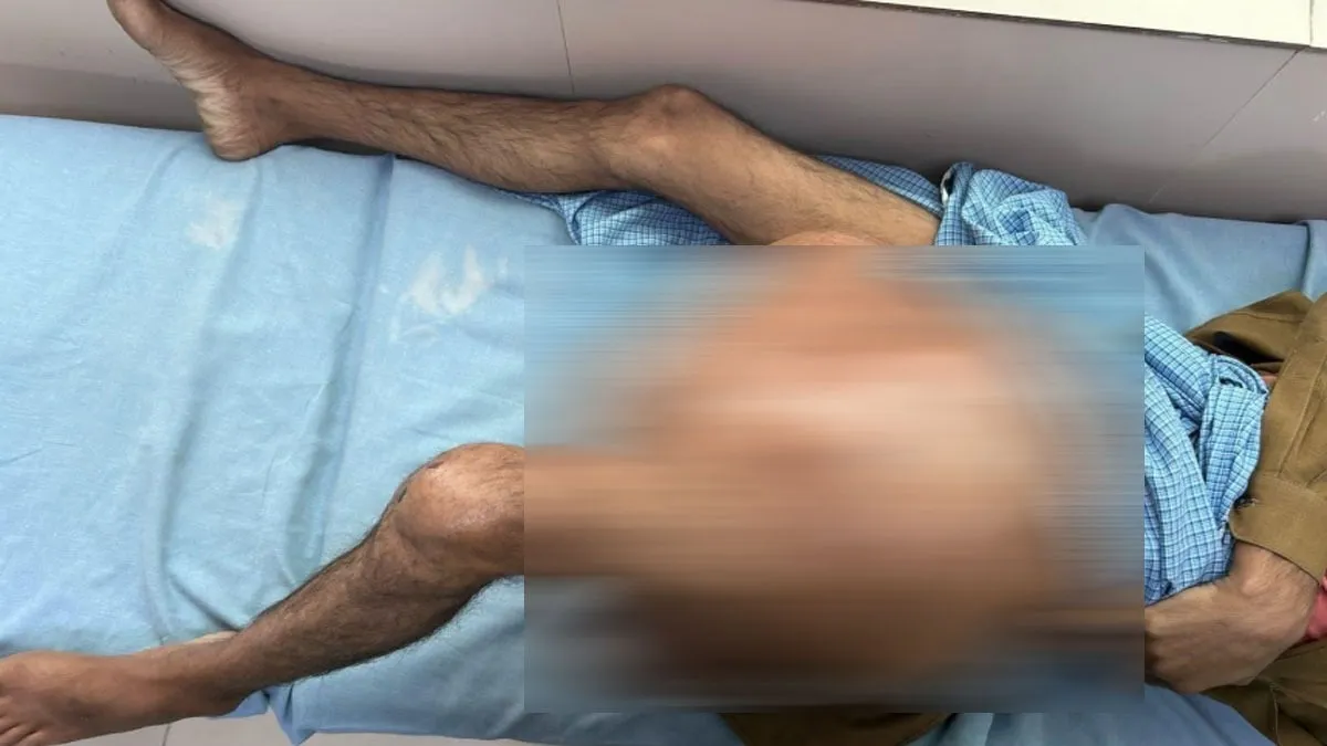 OMG: युवक के पैर पर बना था 35 किलो का बड़ा ट्यूमर, एम्स ऋषिकेश में हुई सफल सर्जरी