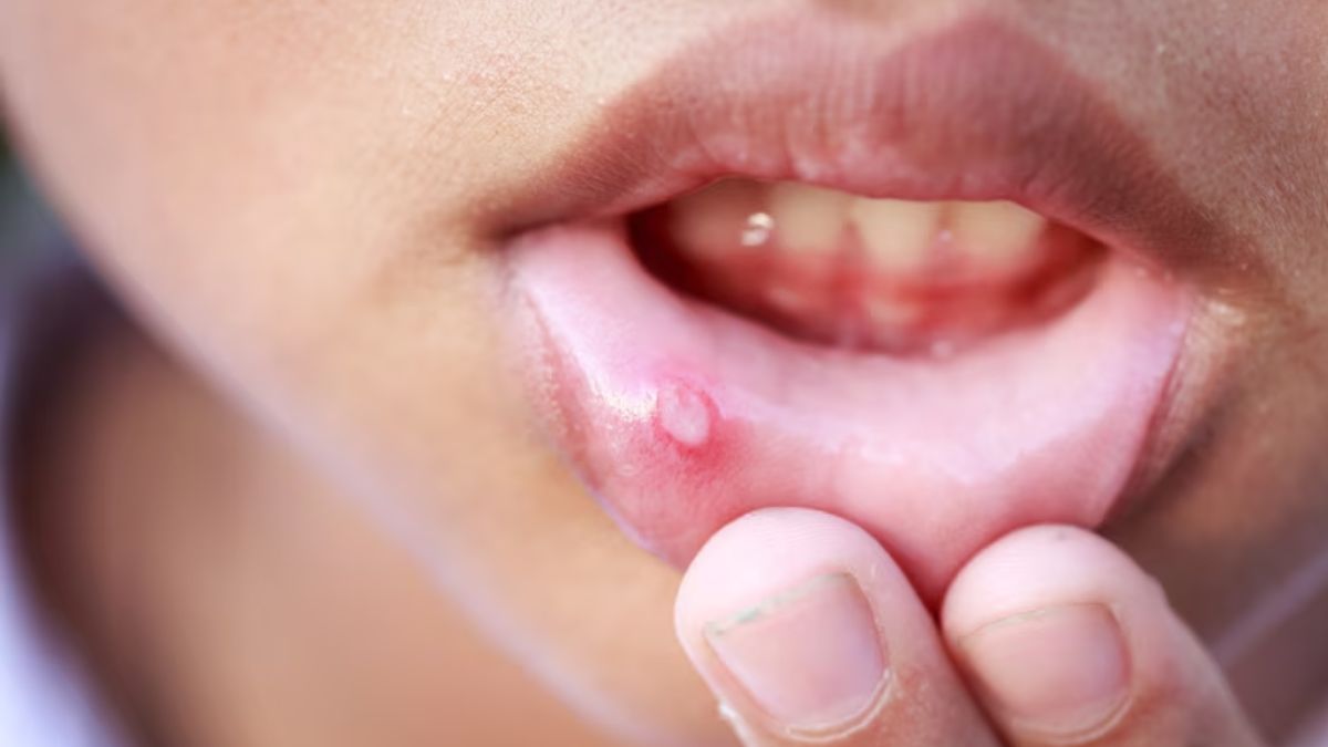 https://www.jagranimages.com/images/2025/06/27/article/image/mouth-ulcers-1751019365624.jpg