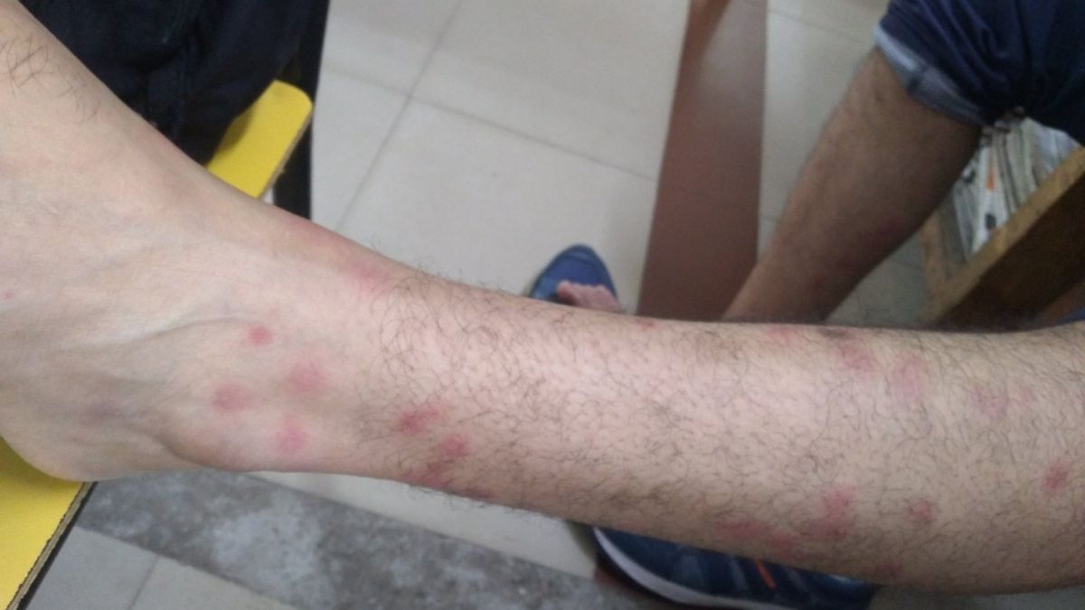 dhanbad railway bed bugs in ac room rat bite in train expose poor maintenance