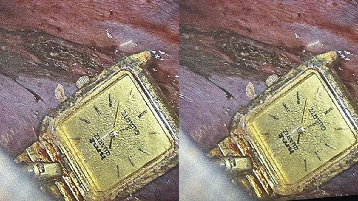 nuts bolts and a watch were found in the young man stomach