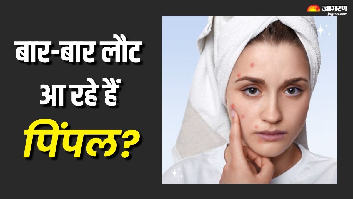 5 mistakes which are causing persistent acne check details here