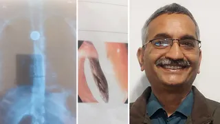युवती के खाने की नली में फंसा सिक्का व ऑपरेशन करने वाले डाॅक्टर बृज शर्मा।