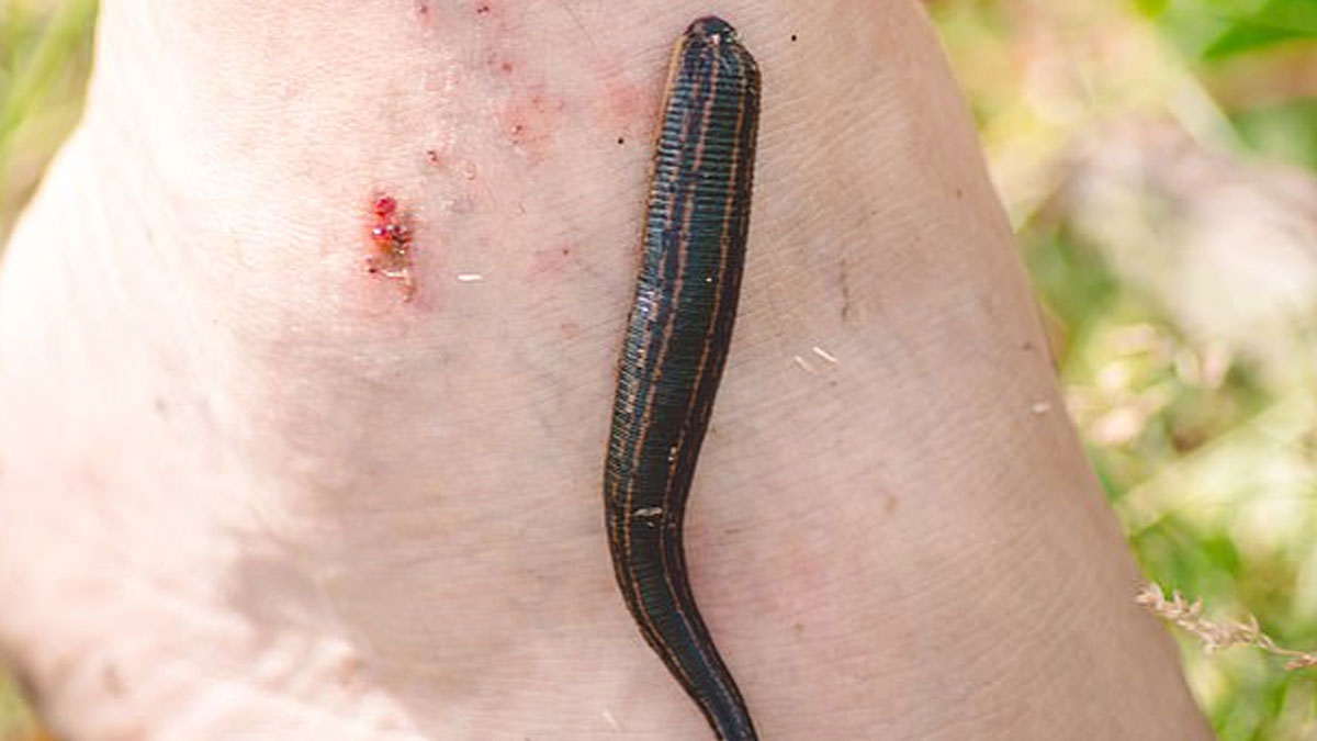 leech therapy started in uttarakhand