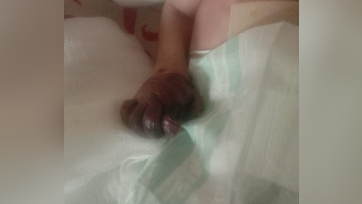 noida infants hand saved after negligence surgery successful