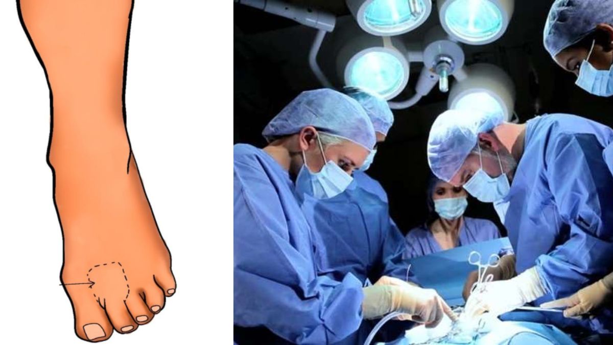 doctors reconstruct thumb with toe at sir ganga ram hospital