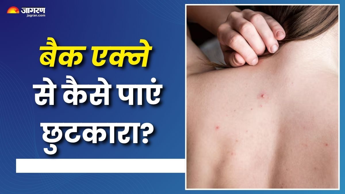 5 effective tips to get rid of back acne check details here