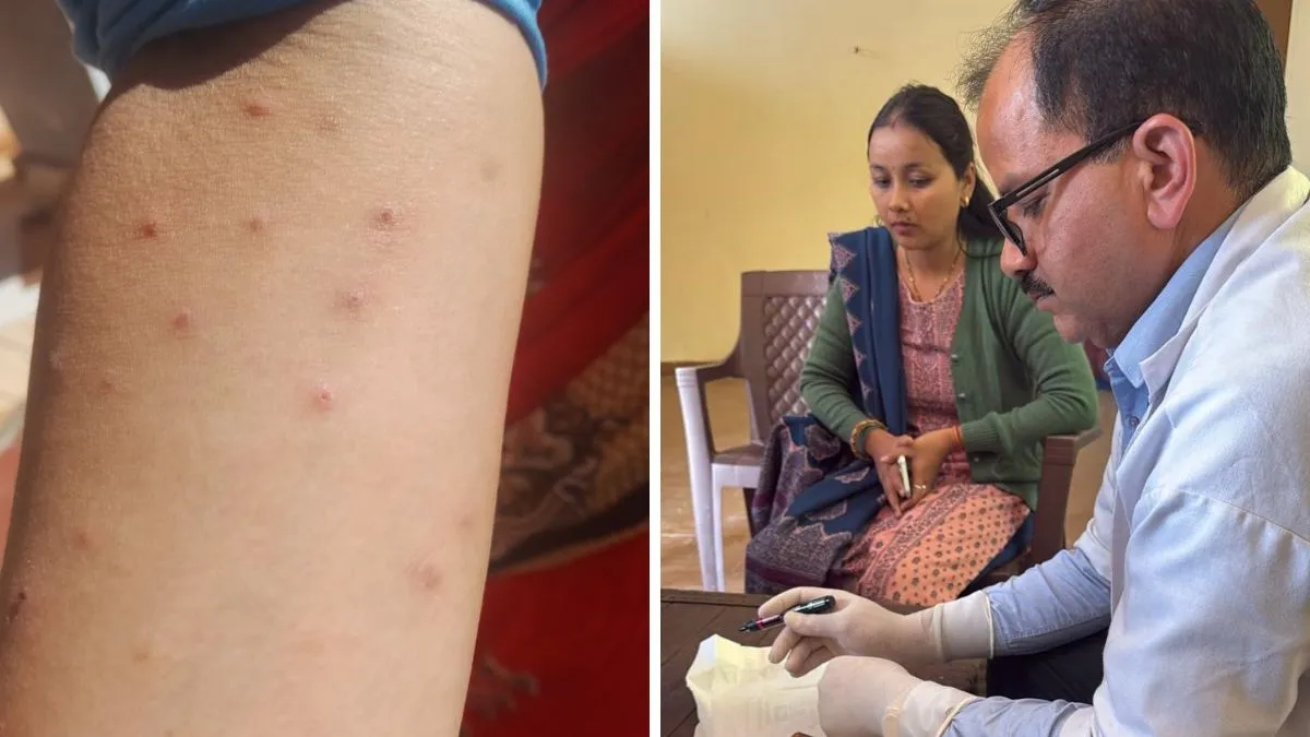 चमोली के रानौ गांव में 80 से अधिक लोग खुजली की शिकायत से परेशान, स्वास्थ्य विभाग की टीम ने की मरीजों की जांच
