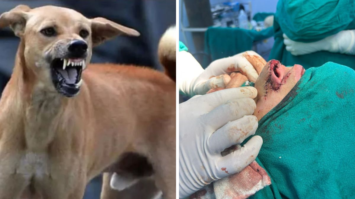 dog bite victim undergoes successful nose reconstruction surgery