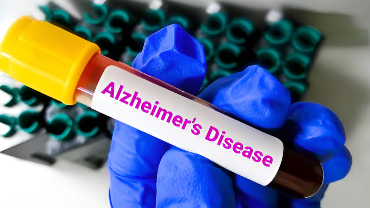 new model predicts alzheimer risk 10 years before symptoms check details