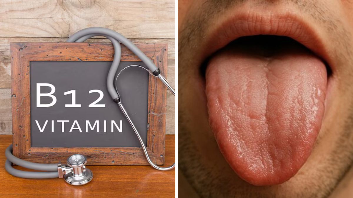 vitamin b12 deficiency 3 big signs of b12 deficiency seen on the tongue check today