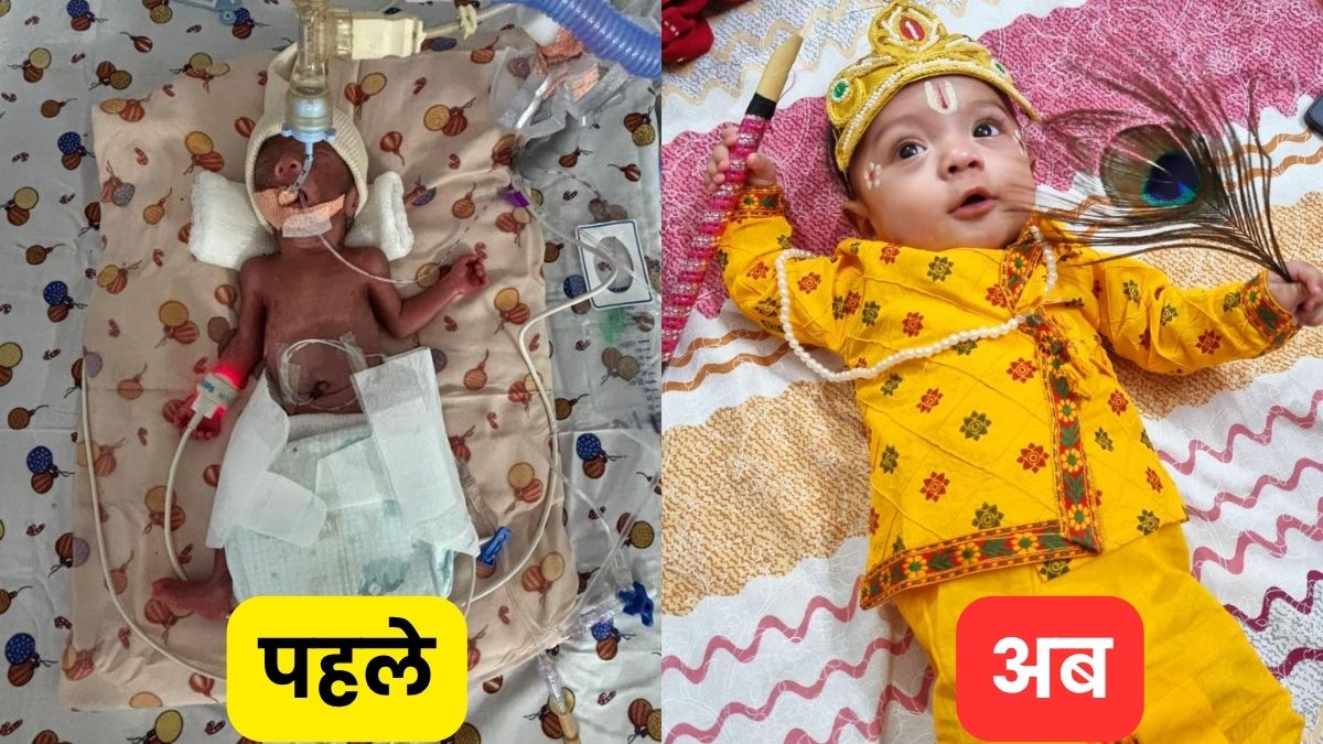 premature baby survival fortis delhi saves 24weekold infant