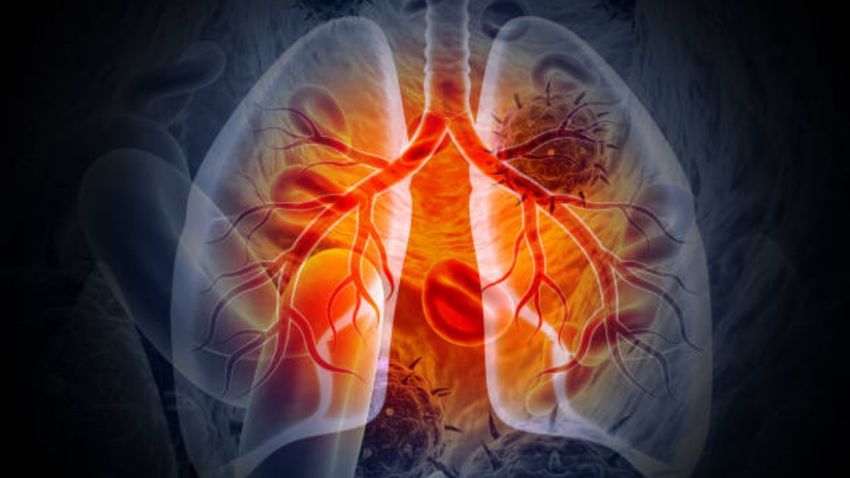 big success against lung cancer scientists discover a way to shrink tumors by up to 80 percent