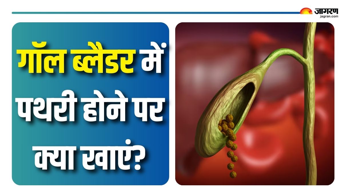 foods to eat and to avoid to treat gallstones check details here