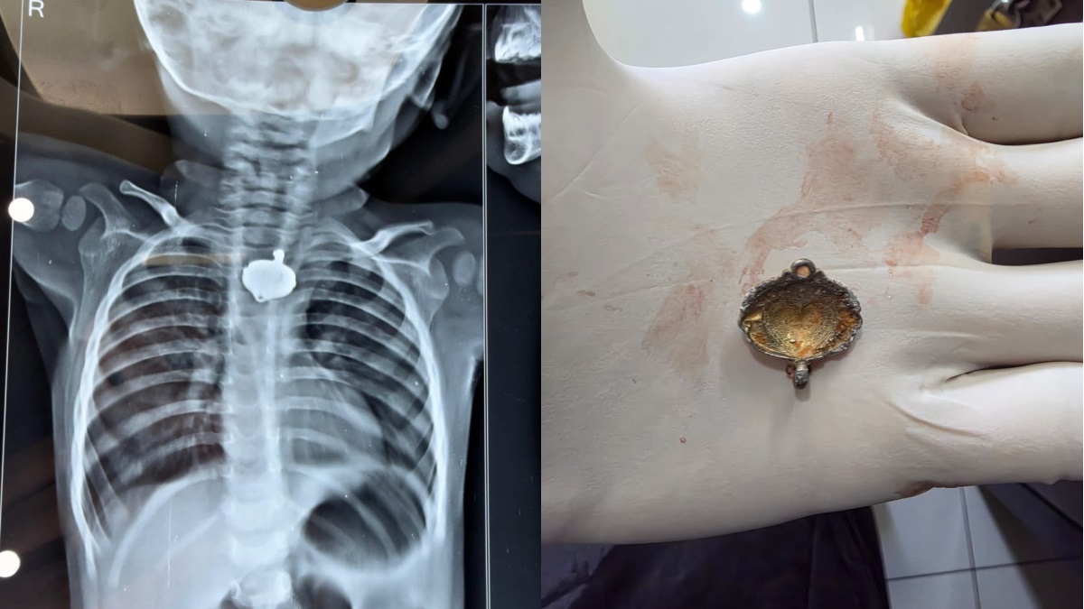infant choking hazard mangalsutra pendant lodged in babys throat