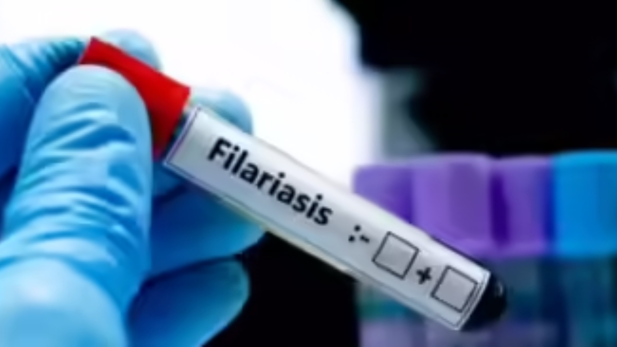 night blood survey for filariasis elimination in chhapra