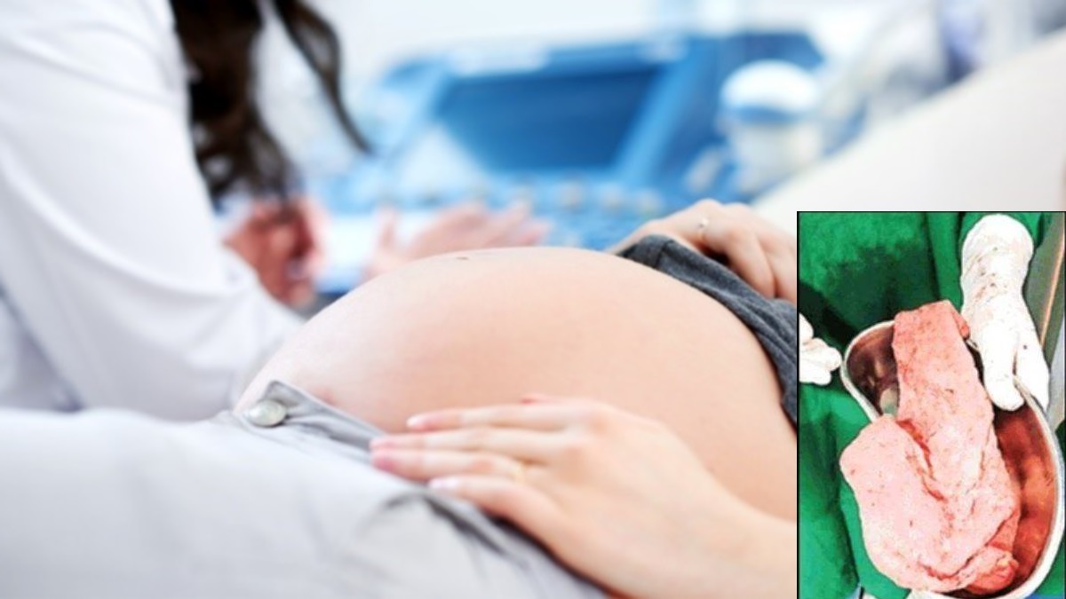 chhindwara hospital negligence cloth left inside woman after delivery