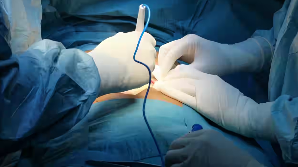 massive facial tumor removed fortis hospital saves kyrgyz man