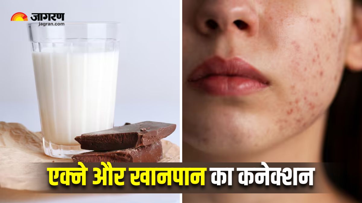 does chocolate or milk cause acne foods to avoid for clear skin dermatologist tips