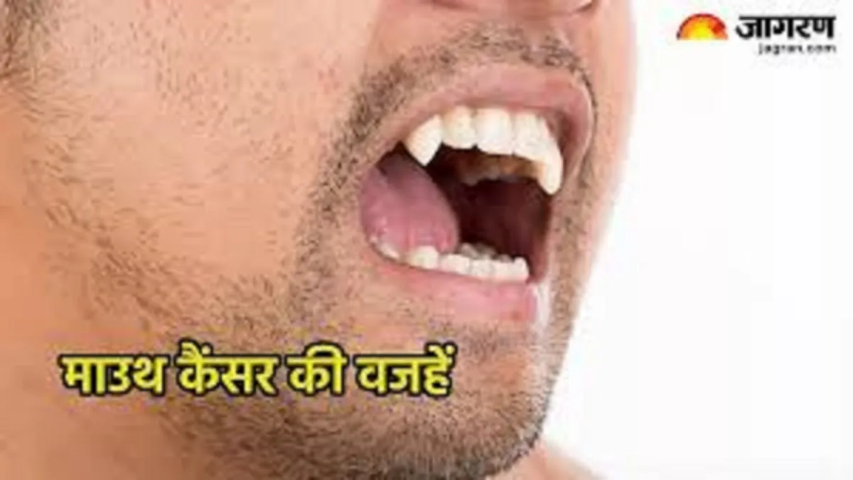 शीशे में देखें अपना चेहरा, मुंह कैंसर के लक्षणों को पहचानें, असामान्यता दिखे तो सतर्क हो जाएं और तत्काल कराएं इलाज
