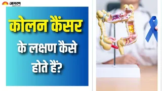 युवाओं में क्यों बढ़ रहा है कोलन कैंसर? (Picture Courtesy: Freepik)
