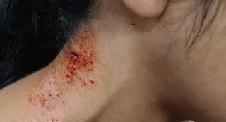कुत्तों के काटे जाने के बाद जख्मी महिला।