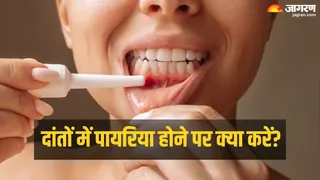 दांतों में पायरिया होने पर इन बातों का रखें ध्यान। (Picture Credit - Canva)
