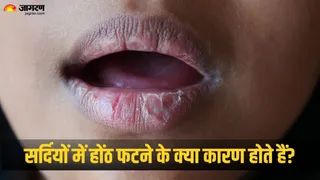 होंठ फटने के लिए इन कारणों का न करें नजरअंदाज (Picture Credit - Canva)