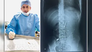 गैस्ट्रो सर्जन डा. रियाज मरीज के पेट से लाेहे की कील के साथ। सौ. स्वयं