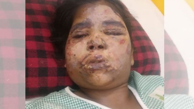 पूर्वी चंपारण में कुकर फटने से मां समेत तीन बच्चे गंभीर रूप से झुलसे