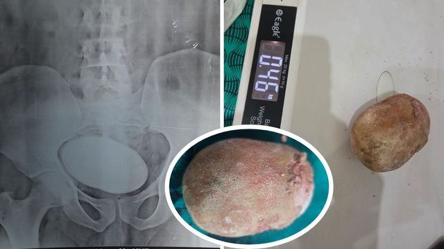 मरीज की पेशाब की थैली से निकली दुर्लभ पथरी, साइज और वजन देखकर डॉक्टर भी रह गए हैरान
