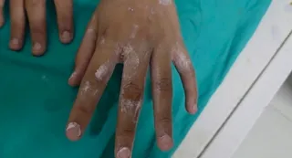 झुलसी उंगलियां। जागरण