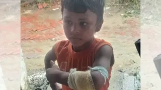 पूर्वी चंपारण में सियार के हमले में घायल बच्चा।