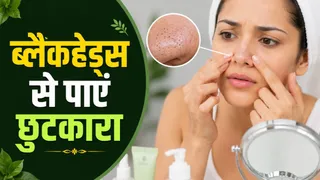 जिद्दी ब्लैकहेड्स से पाएं हमेशा के लिए छुटकारा (Picture Credit- AI Generated)