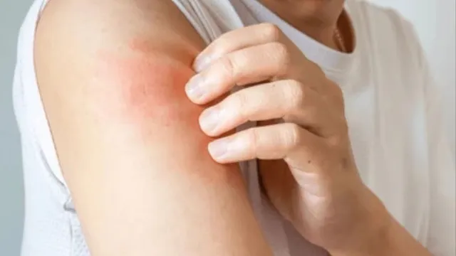 https://www.jagranimages.com/images/2026/08/11/template/image/monsoon-Skin-Infection-1786447431464.webp