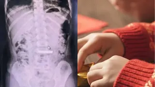 चीन में बच्ची ने निगला 50 ग्राम सोने का बिस्किट